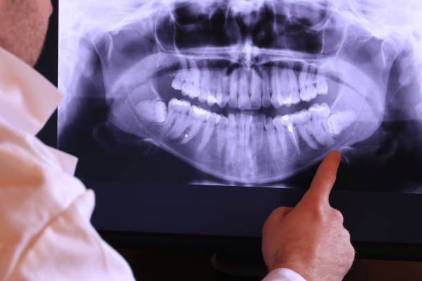 Best Emergency Tooth Extraction in Binghamton University, NY